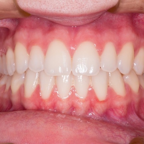 witte tanden en kiezen