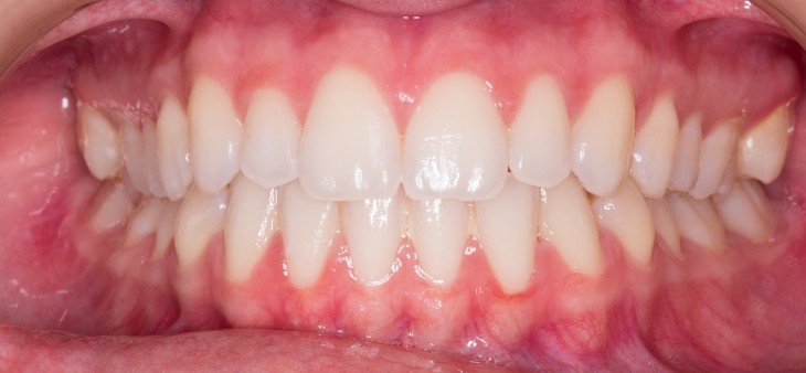 witte tanden en kiezen